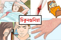 ঘরে বসেই চিকুনগুনিয়ার চিকিৎসা