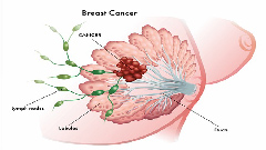 কেমোথেরাপি ছাড়াই ব্রেস্ট ক্যান্সার থেকে মুক্তি