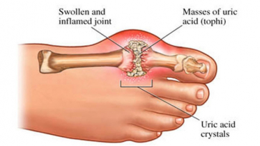 ‘ইউরিক এসিড’ কেন বাড়ে, বাড়লে কী করণীয়?