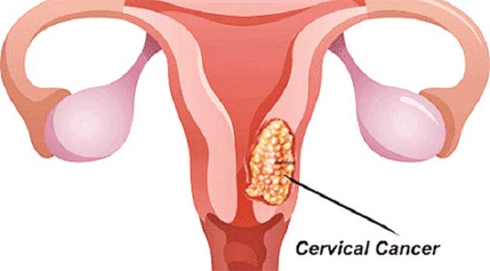 ‘ভায়া’ সারাবে জরায়ু মুখের ক্যান্সার