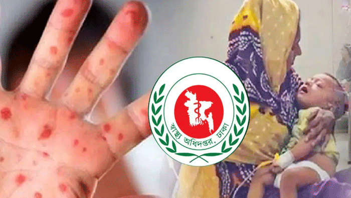 হামে আক্রান্ত রোগী