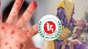 হাম উপসর্গে আরও ৬ প্রাণহানি, নতুন ভার্তি ১,৩৯৩