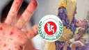একদিনে হাম উপসর্গে আরও ৭ প্রাণহানি, নতুন ভর্তি ১১৩৫ 