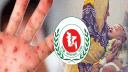 এক দিনে হাম উপসর্গে আরও ৬ জনের মৃত্যু