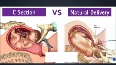 সিজারিয়ান, নাকি নরমাল ডেলিভারি?