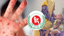 একদিনে হাম উপসর্গে আরও ৫ শিশুর মৃত্যু