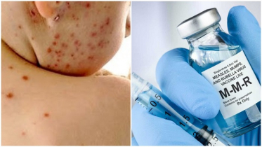 রোববার শুরু হচ্ছে জরুরি হাম-রুবেলা টিকাদান রোববার শুরু হচ্ছে জরুরি হাম-রুবেলা টিকাদান