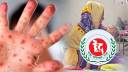 হাম-উপসর্গে আরও ৫ শিশুর মৃত্যু, নতুন আক্রান্ত ১০২৫