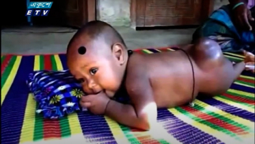 টাকার অভাবে চিকিৎসা পাচ্ছে না শিশু বনমালী (ভিডিও)