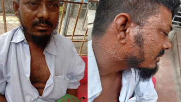 ভারত ফেরত চিকেন পক্স আক্রান্ত যাত্রীকে হাসপাতালে স্থানান্তর