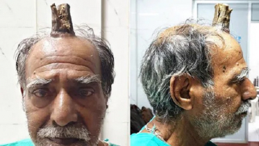 মাথায় লম্বা ‘শিং’ নিয়ে বিপাকে বৃদ্ধ, অতঃপর...