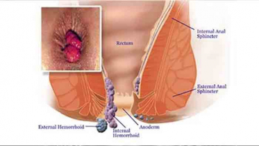পাইলস কেন হয়? প্রতিকারে যা করণীয়
